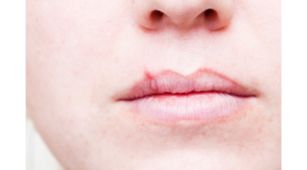 Get Rid of Cold Sores Fast