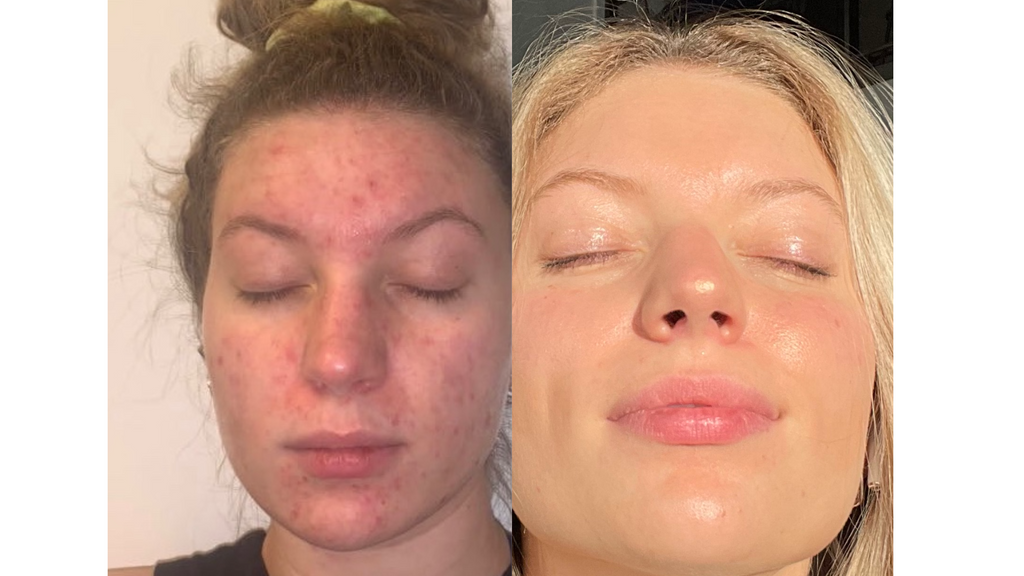 Acne before and after female face 